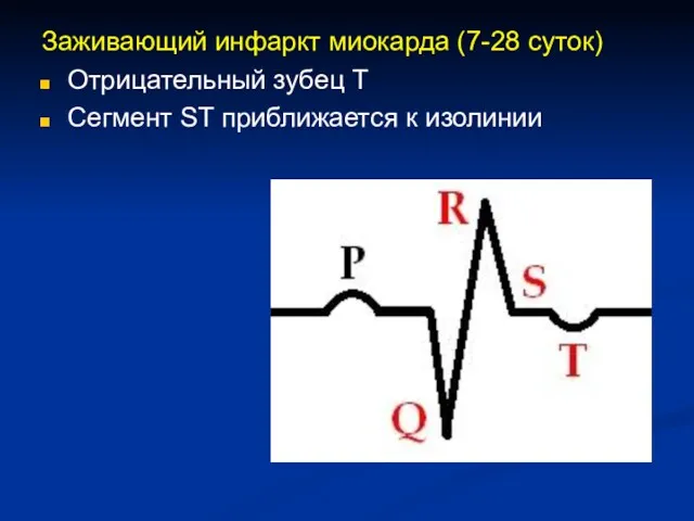 Заживающий инфаркт миокарда (7-28 суток) Отрицательный зубец T Сегмент ST приближается к изолинии