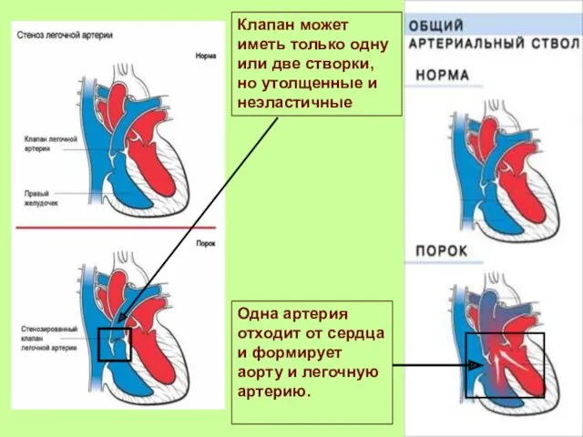 Одна артерия отходит от сердца и формирует аорту и легочную артерию. Клапан может
