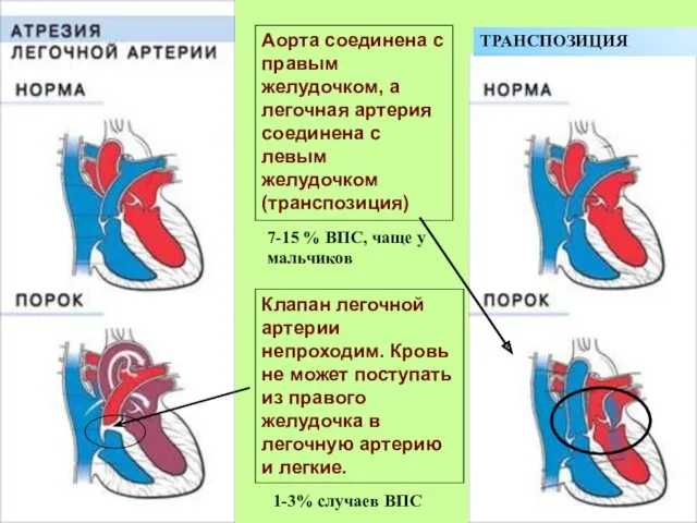 Клапан легочной артерии непроходим. Кровь не может поступать из правого желудочка в легочную