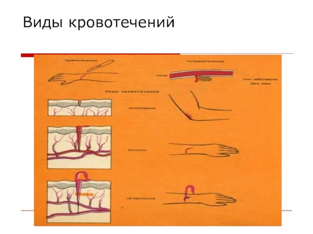 Виды кровотечений