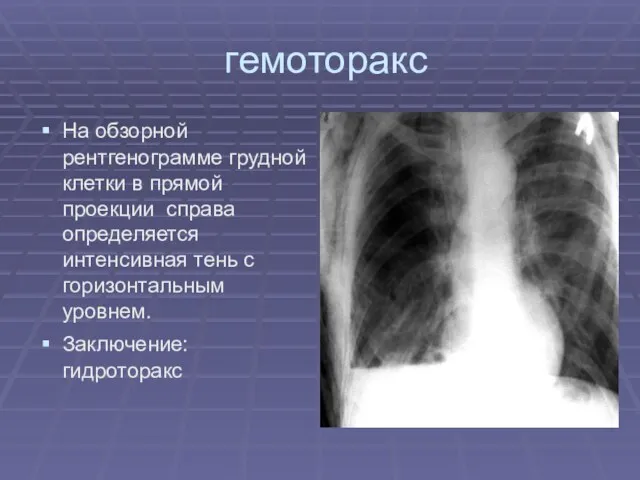 гемоторакс На обзорной рентгенограмме грудной клетки в прямой проекции справа