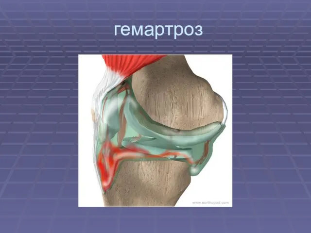 гемартроз