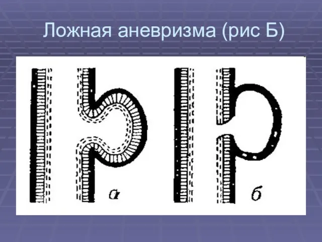 Ложная аневризма (рис Б)