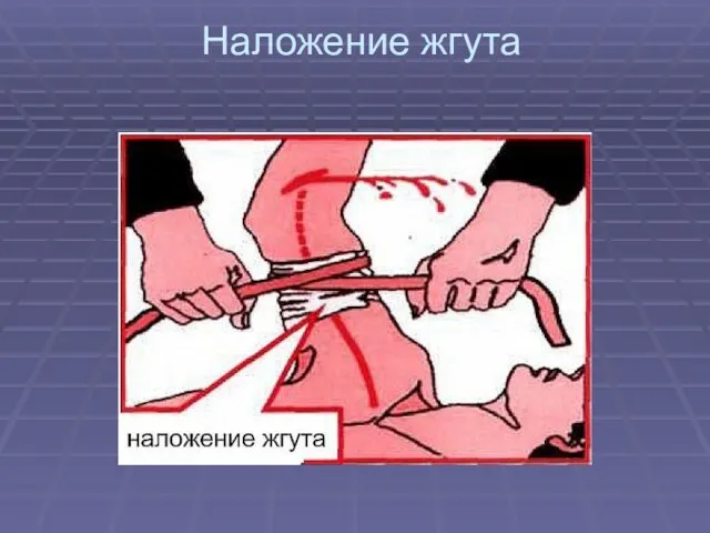 Наложение жгута