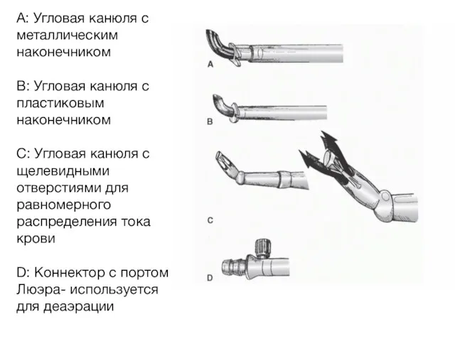 А: Угловая канюля с металлическим наконечником В: Угловая канюля с