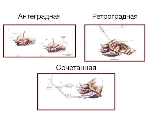 Антеградная Ретроградная Сочетанная