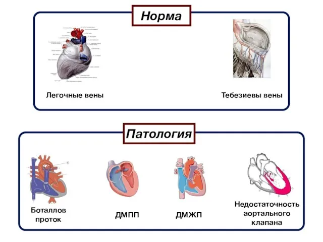 Норма Легочные вены Тебезиевы вены Патология Боталлов проток ДМПП ДМЖП Недостаточность аортального клапана
