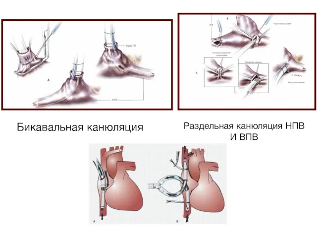 Бикавальная канюляция Раздельная канюляция НПВ И ВПВ