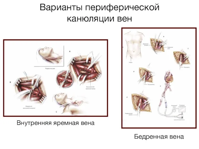 Внутренняя яремная вена Варианты периферической канюляции вен Бедренная вена