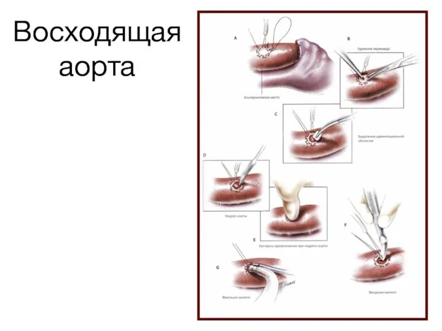 Восходящая аорта