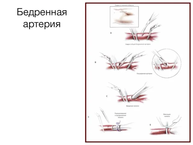 Бедренная артерия