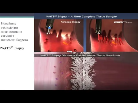 Новейшие технологии диагностики в сегменте пищевода Баррета WATS3D Biopsy