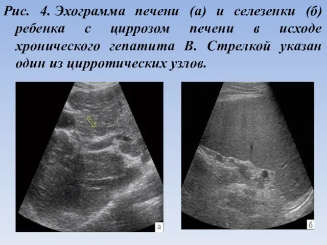 Рис. 4. Эхограмма печени (а) и селезенки (б) ребенка с циррозом печени в