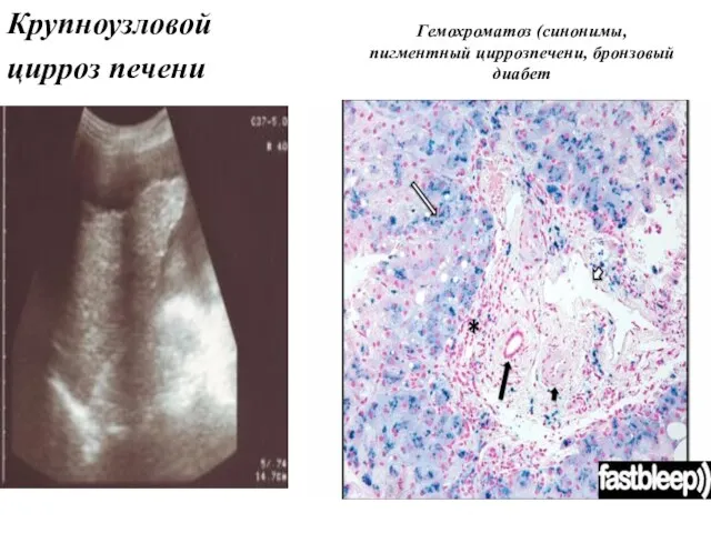 Крупноузловой цирроз печени Гемохроматоз (синонимы, пигментный циррозпечени, бронзовый диабет