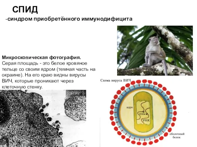 СПИД -синдром приобретённого иммунодифицита Микроскопическая фотография. Серая площадь - это