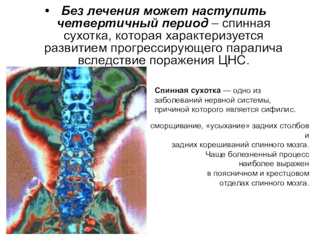 Без лечения может наступить четвертичный период – спинная сухотка, которая