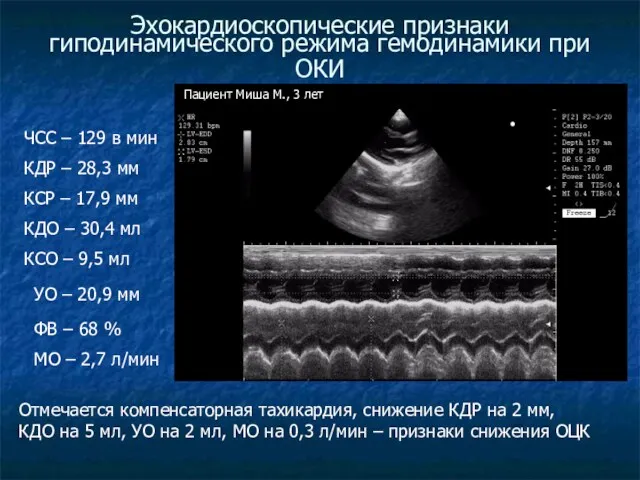 Эхокардиоскопические признаки гиподинамического режима гемодинамики при ОКИ ЧСС – 129