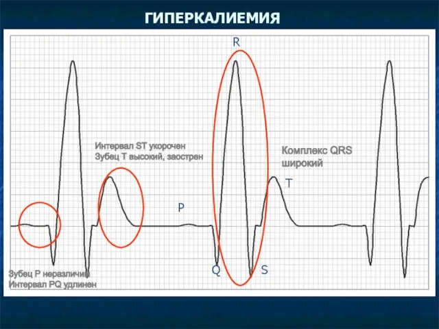 ГИПЕРКАЛИЕМИЯ Интервал ST укорочен Зубец Т высокий, заострен Зубец Р