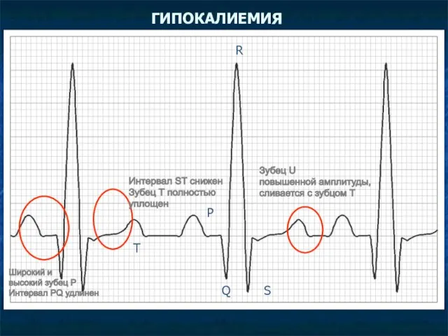 ГИПОКАЛИЕМИЯ Зубец U повышенной амплитуды, сливается с зубцом Т Интервал