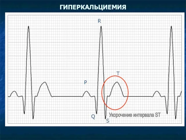 ГИПЕРКАЛЬЦИЕМИЯ Укорочение интервала SТ P Q R S T