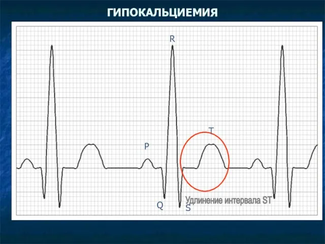 ГИПОКАЛЬЦИЕМИЯ Удлинение интервала SТ P Q R S T