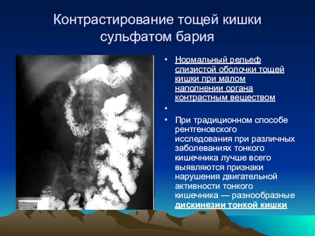 Контрастирование тощей кишки сульфатом бария Нормальный рельеф слизистой оболочки тощей