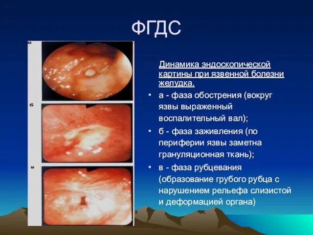 ФГДС Динамика эндоскопической картины при язвенной болезни желудка. а -