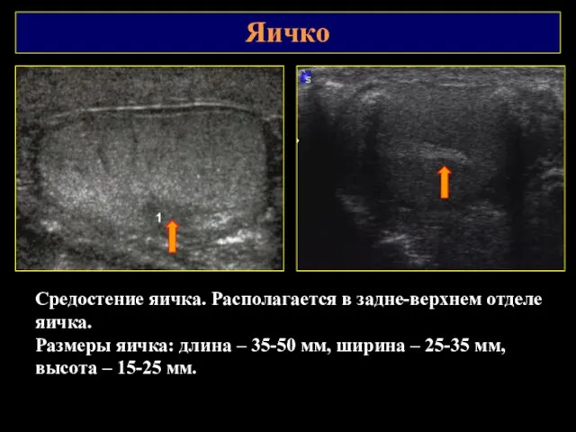 Яичко Средостение яичка. Располагается в задне-верхнем отделе яичка. Размеры яичка: