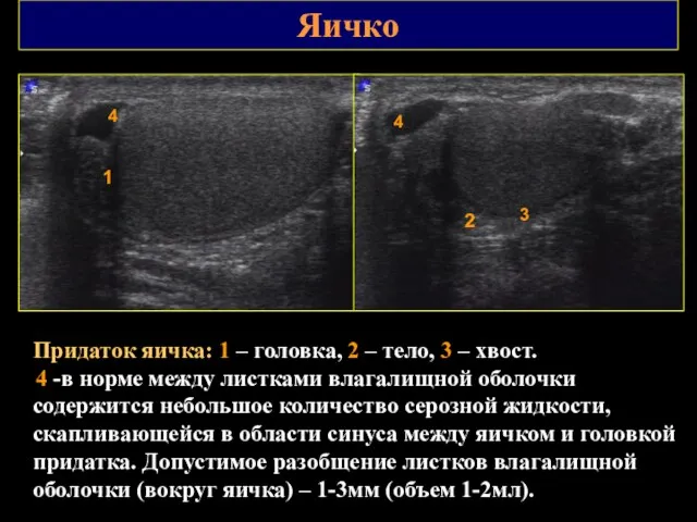 Яичко Придаток яичка: 1 – головка, 2 – тело, 3