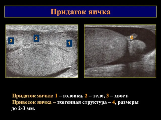 Придаток яичка Придаток яичка: 1 – головка, 2 – тело,