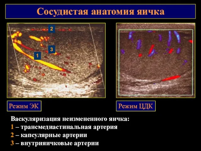 Сосудистая анатомия яичка Васкуляризация неизмененного яичка: 1 – трансмедиастинальная артерия