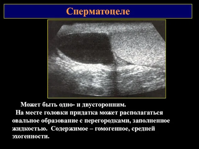 Сперматоцеле Может быть одно- и двусторонним. На месте головки придатка