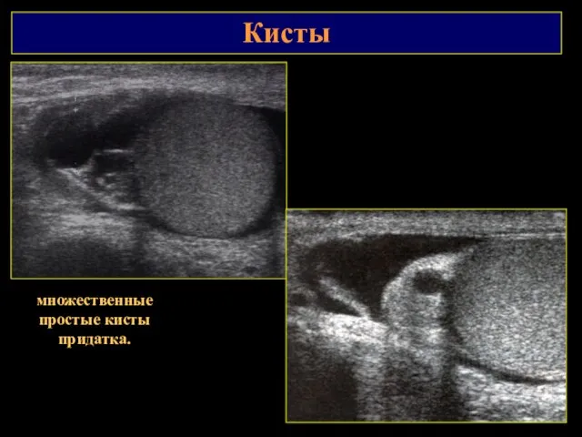Кисты множественные простые кисты придатка.