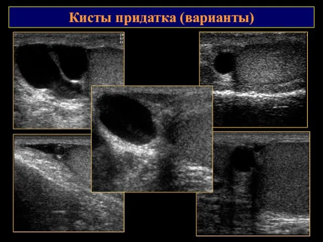 Кисты придатка (варианты)