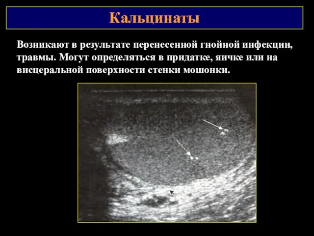 Кальцинаты Возникают в результате перенесенной гнойной инфекции, травмы. Могут определяться