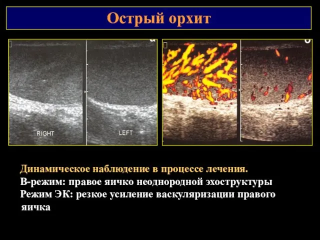 Острый орхит Динамическое наблюдение в процессе лечения. В-режим: правое яичко