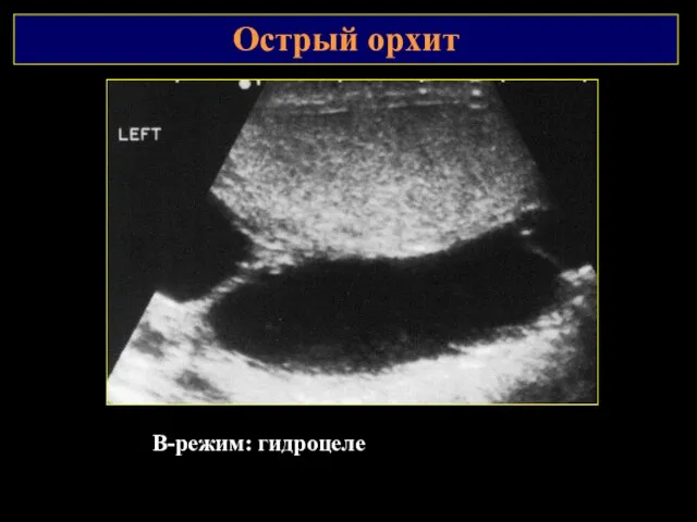 Острый орхит В-режим: гидроцеле