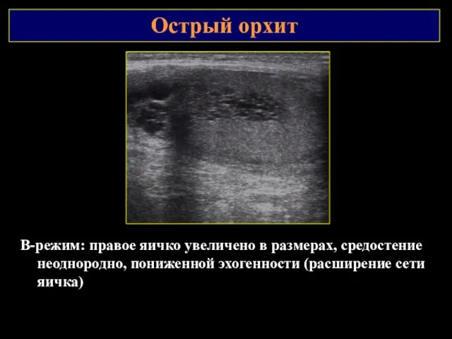 Острый орхит В-режим: правое яичко увеличено в размерах, средостение неоднородно, пониженной эхогенности (расширение сети яичка)