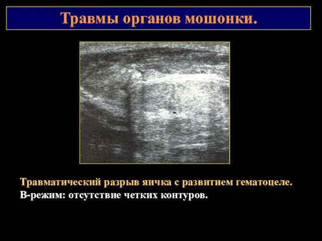 Травмы органов мошонки. Травматический разрыв яичка с развитием гематоцеле. В-режим: отсутствие четких контуров.