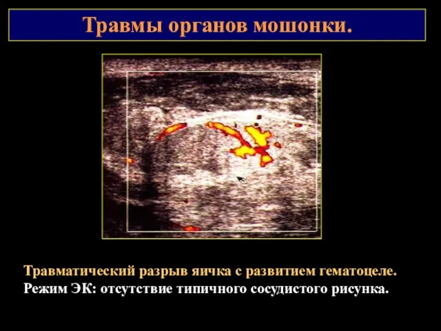 Травмы органов мошонки. Травматический разрыв яичка с развитием гематоцеле. Режим ЭК: отсутствие типичного сосудистого рисунка.