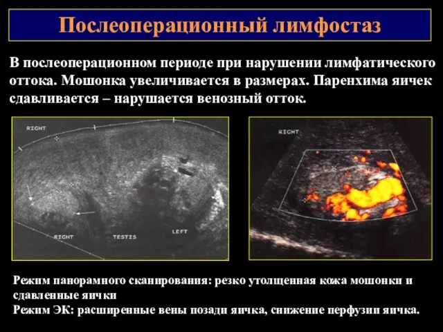 Послеоперационный лимфостаз Режим панорамного сканирования: резко утолщенная кожа мошонки и