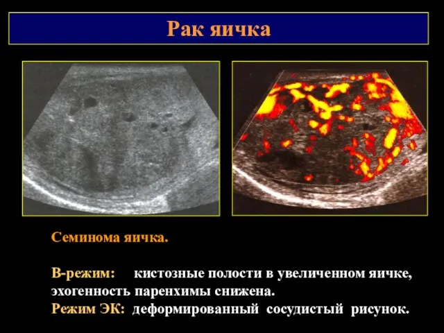 Рак яичка Семинома яичка. В-режим: кистозные полости в увеличенном яичке,