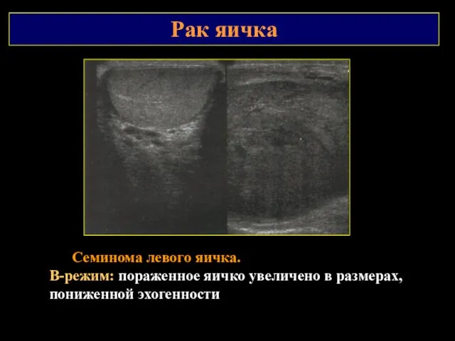 Рак яичка Семинома левого яичка. В-режим: пораженное яичко увеличено в размерах, пониженной эхогенности
