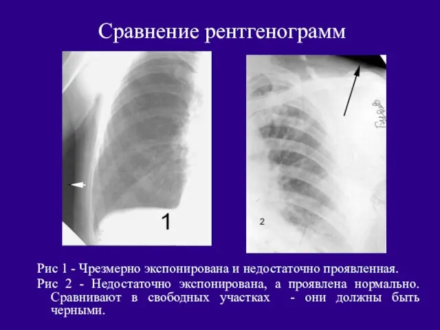 Сравнение рентгенограмм Рис 1 - Чрезмерно экспонирована и недостаточно проявленная.