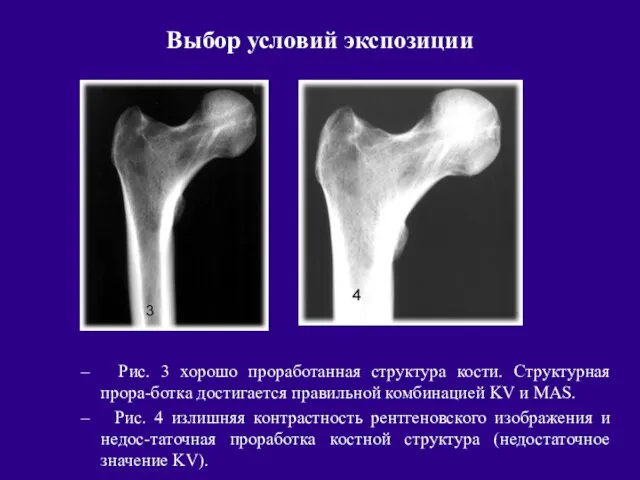 Выбор условий экспозиции Рис. 3 хорошо проработанная структура кости. Структурная