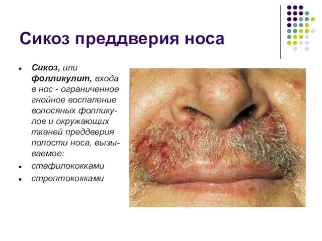 Сикоз преддверия носа Сикоз, или фолликулит, входа в нос - ограниченное гнойное воспаление