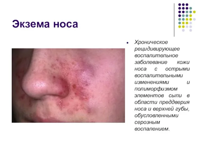 Экзема носа Хроническое рецидивирующее воспалительное заболевание кожи носа с острыми воспалительными изменениями и