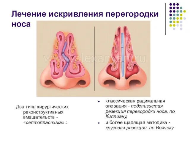 Лечение искривления перегородки носа Два типа хирургических реконструктивных вмешательств -«септопластика» : классическая радикальная