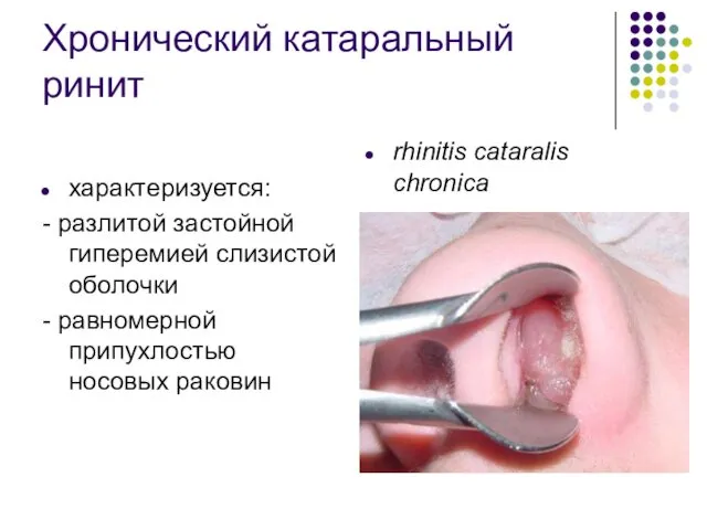 Хронический катаральный ринит характеризуется: - разлитой застойной гиперемией слизистой оболочки - равномерной припухлостью