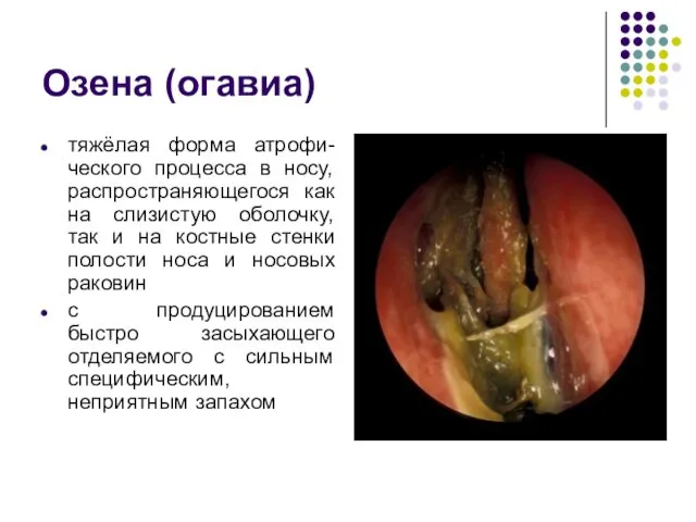 Озена (огавиа) тяжёлая форма атрофи-ческого процесса в носу, распространяющегося как на слизистую оболочку,